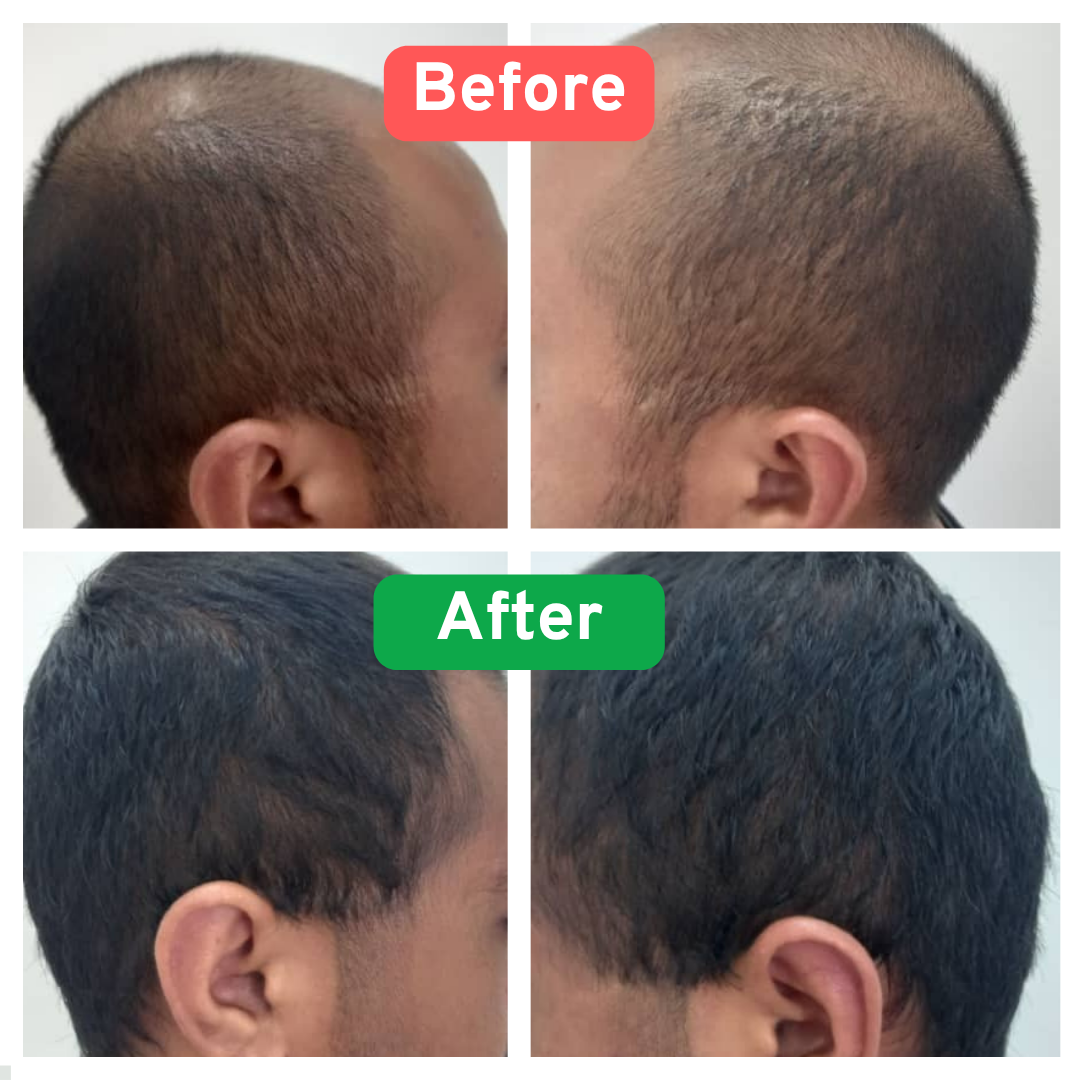 Hair treatment before and after 4 sessions showing regrowth